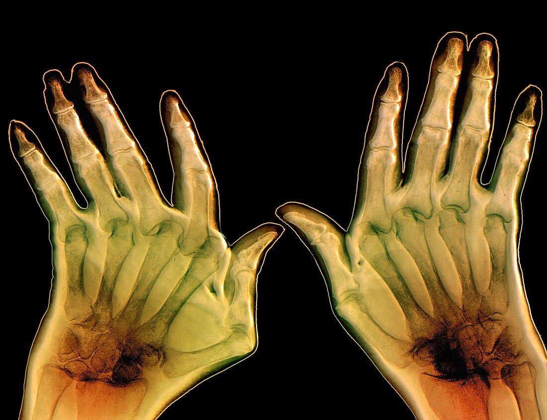 Arthritic hands,X-ray