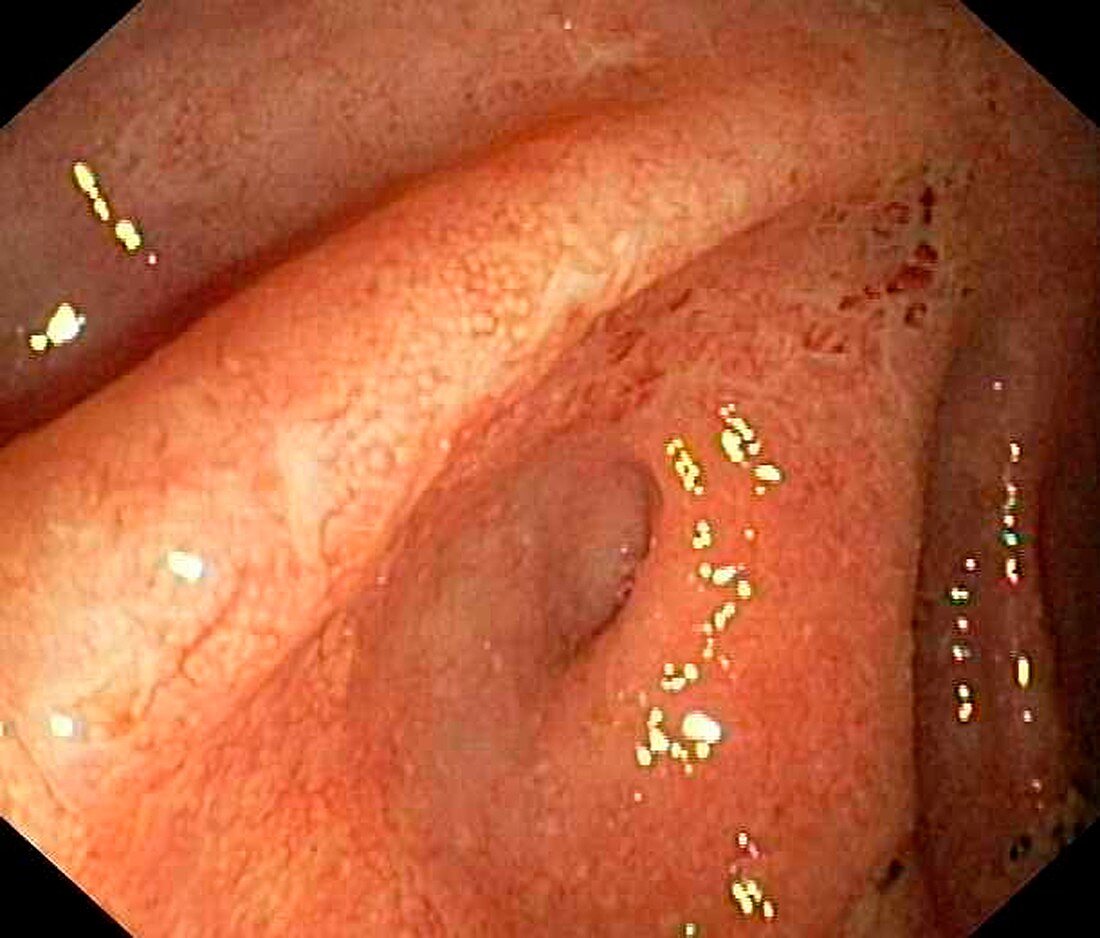 Ulcerative pancolitis