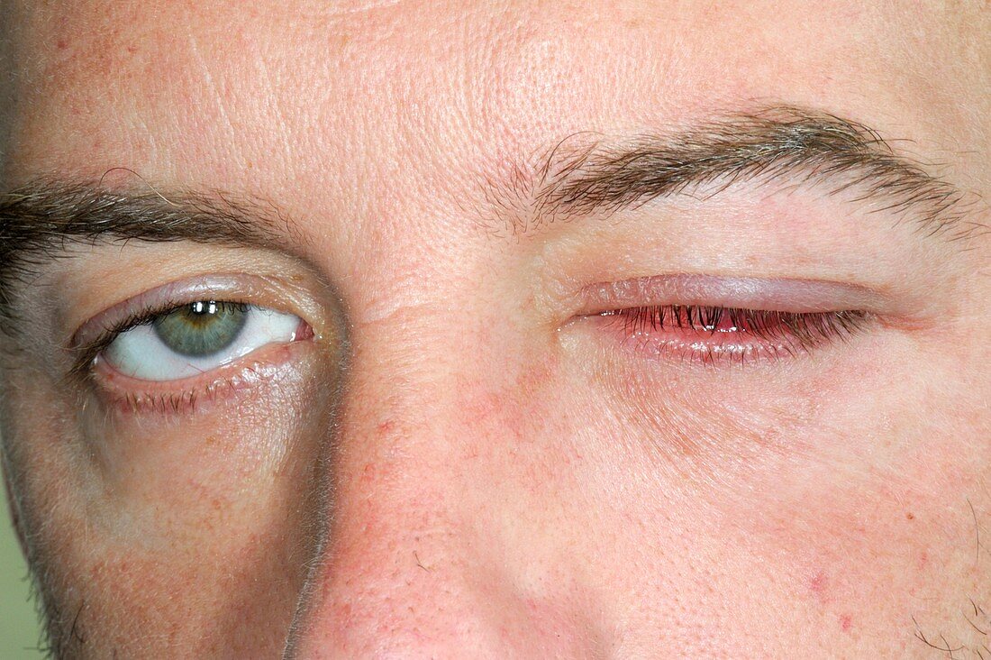 Inflammation of the eye