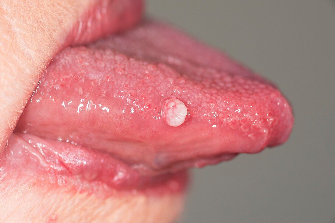 Tongue wart