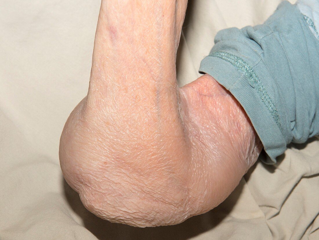 Oedema of the elbow