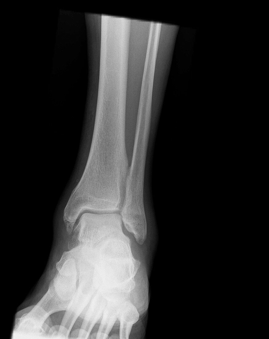 Osteoarthritis of the ankle,X-ray