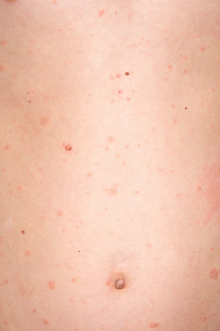 Psoriasis