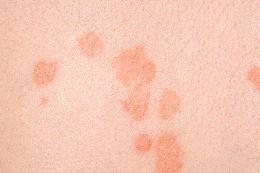 Psoriasis