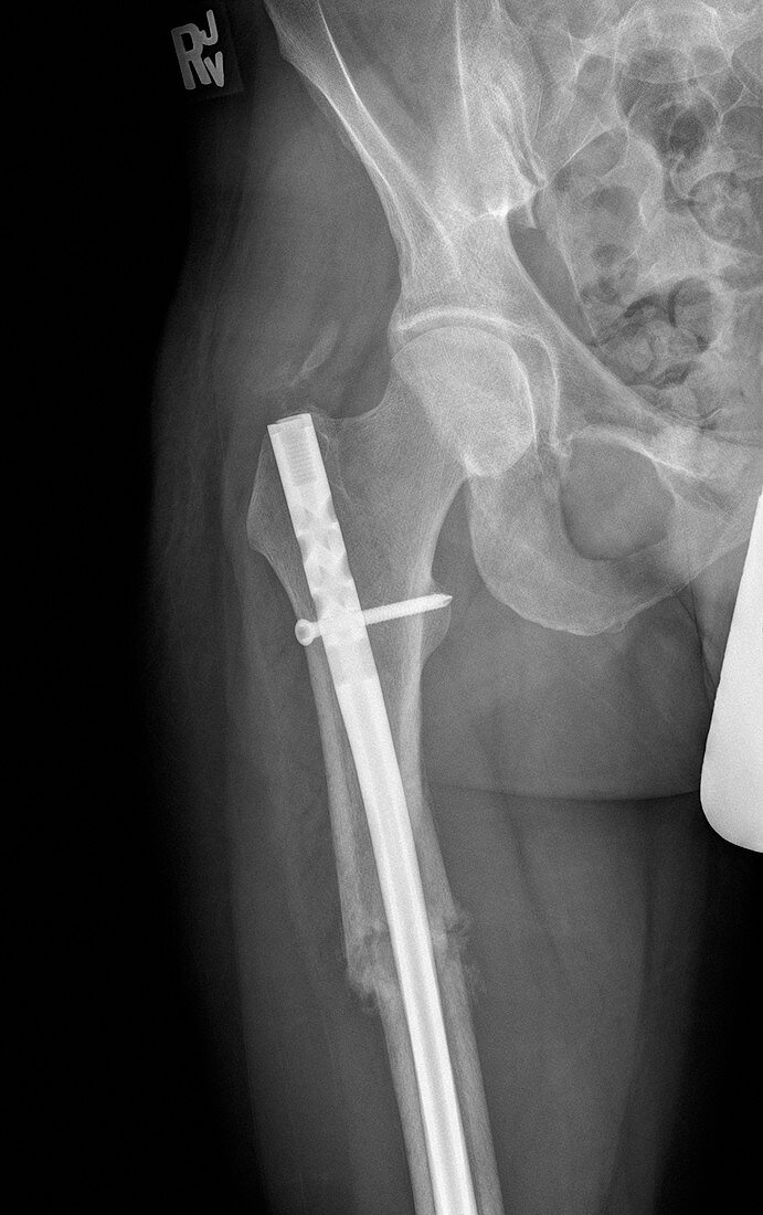 Pinned femur fracture,X-ray