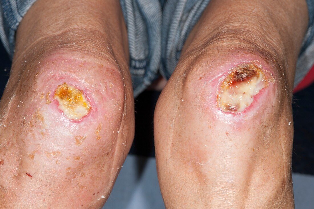 Infected knee grazes