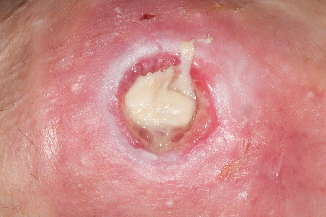 Infected knee ulcer