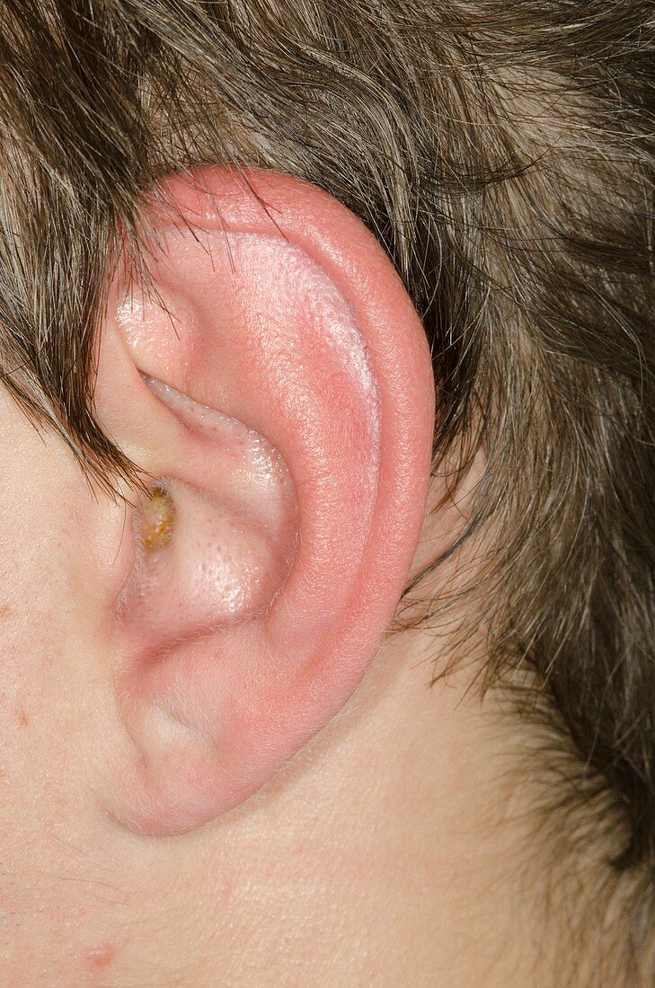 Cellulitis of the ear