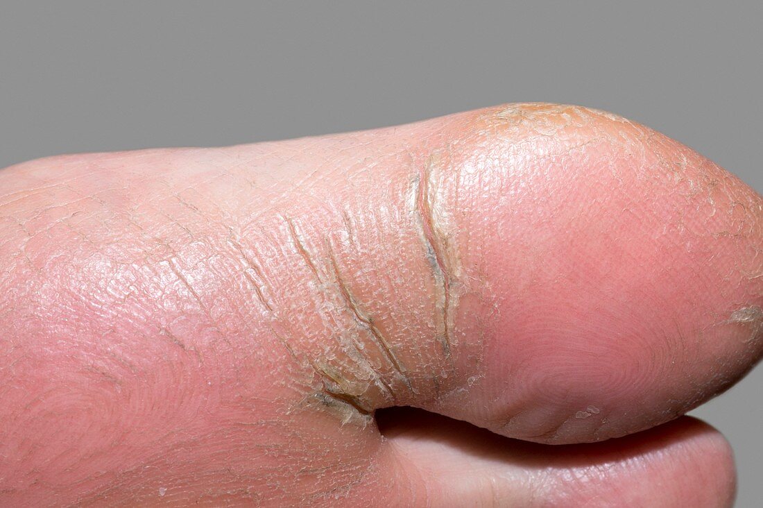 Eczema of the foot