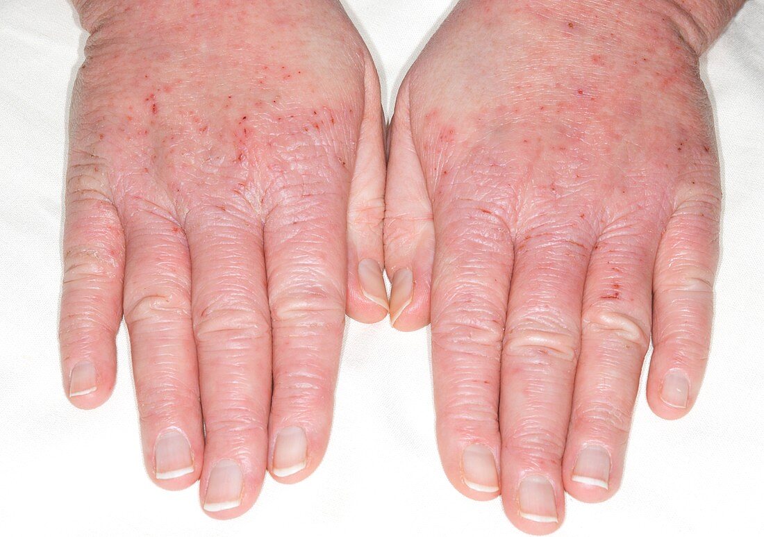 Eczema of the hands