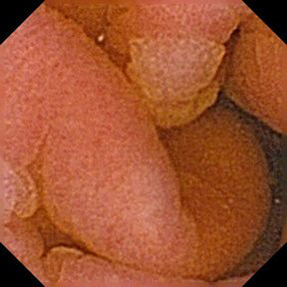 Gastric metaplasia,pill camera view
