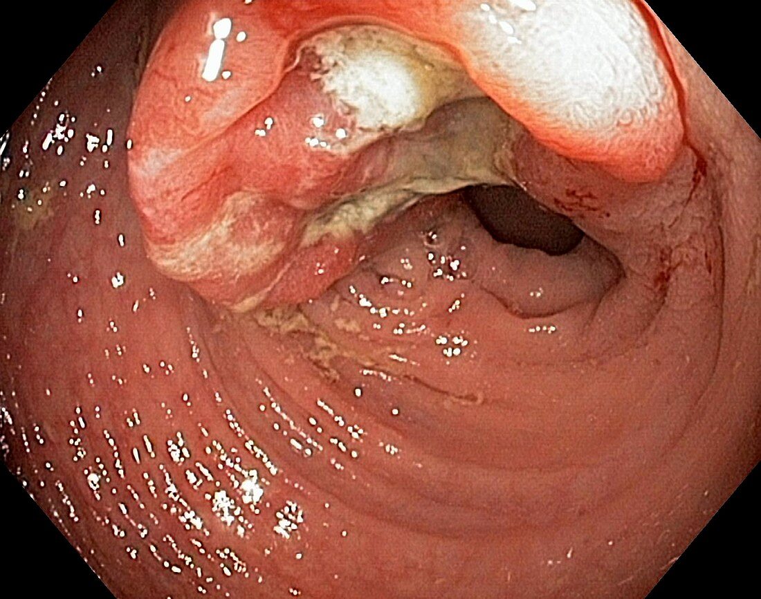 Colon cancer,endoscope view