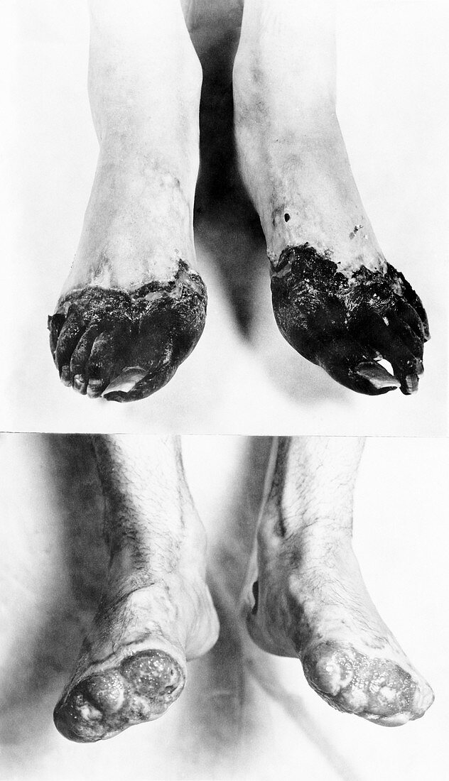 Trench foot