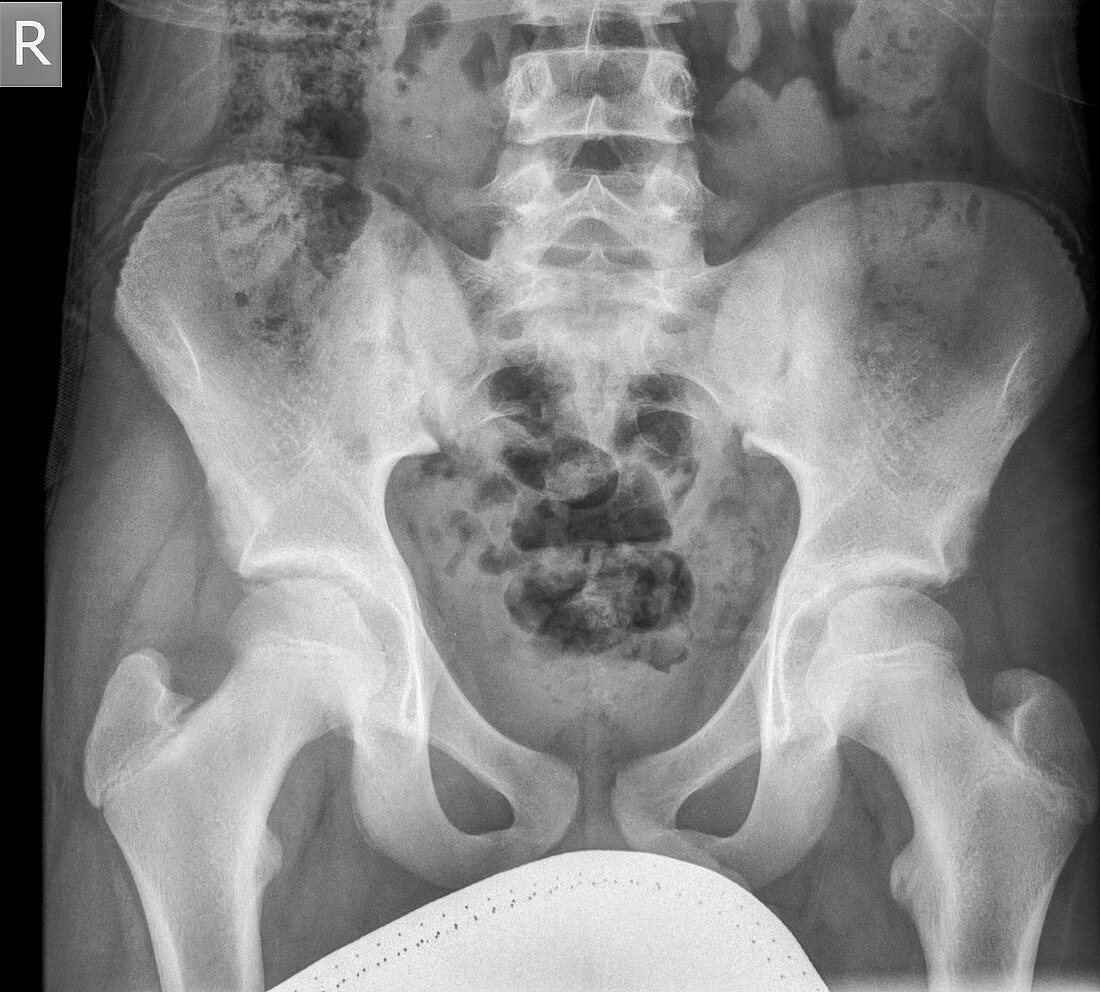 Pelvis x-ray