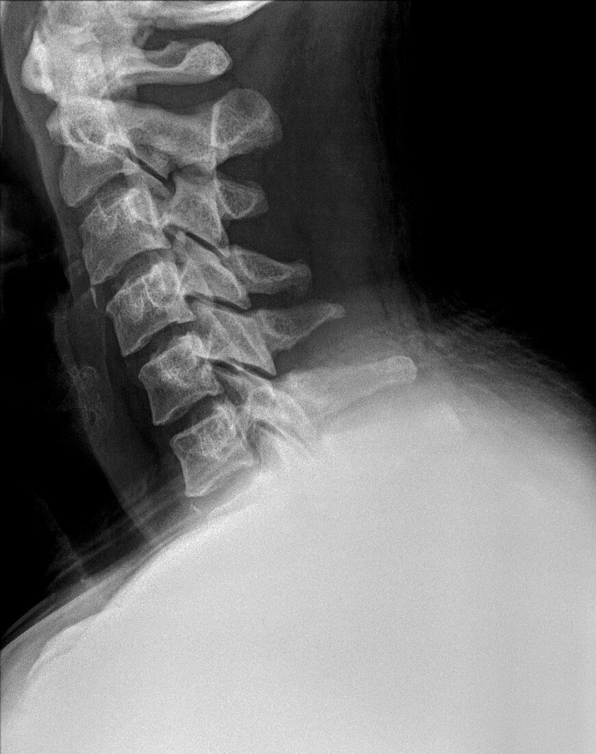 X-ray of a human Cervical spine