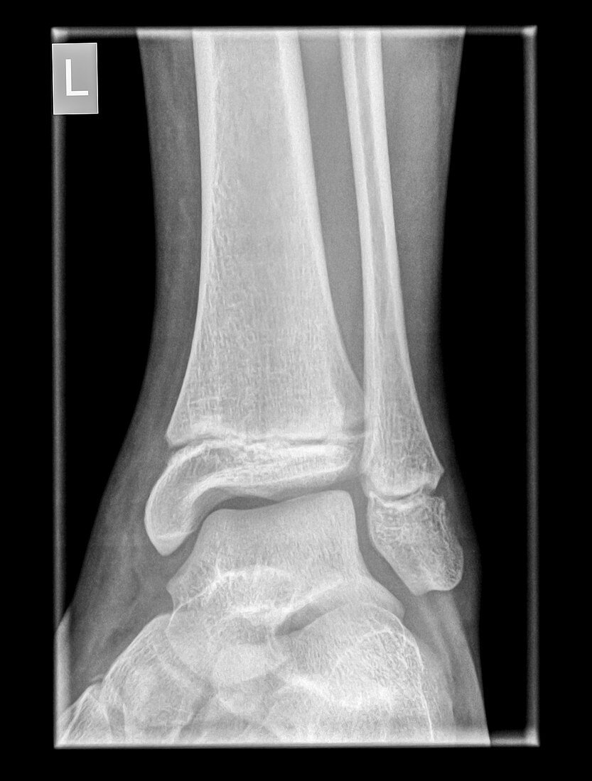 Ankle x-ray