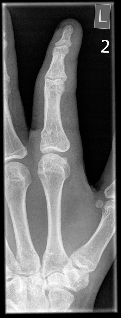 phalanges bones x-ray