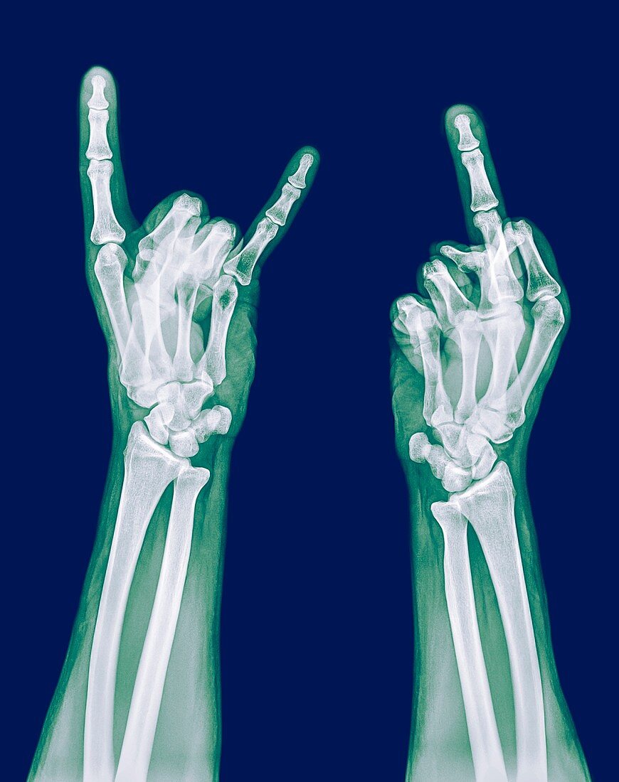obscene gestures x-ray