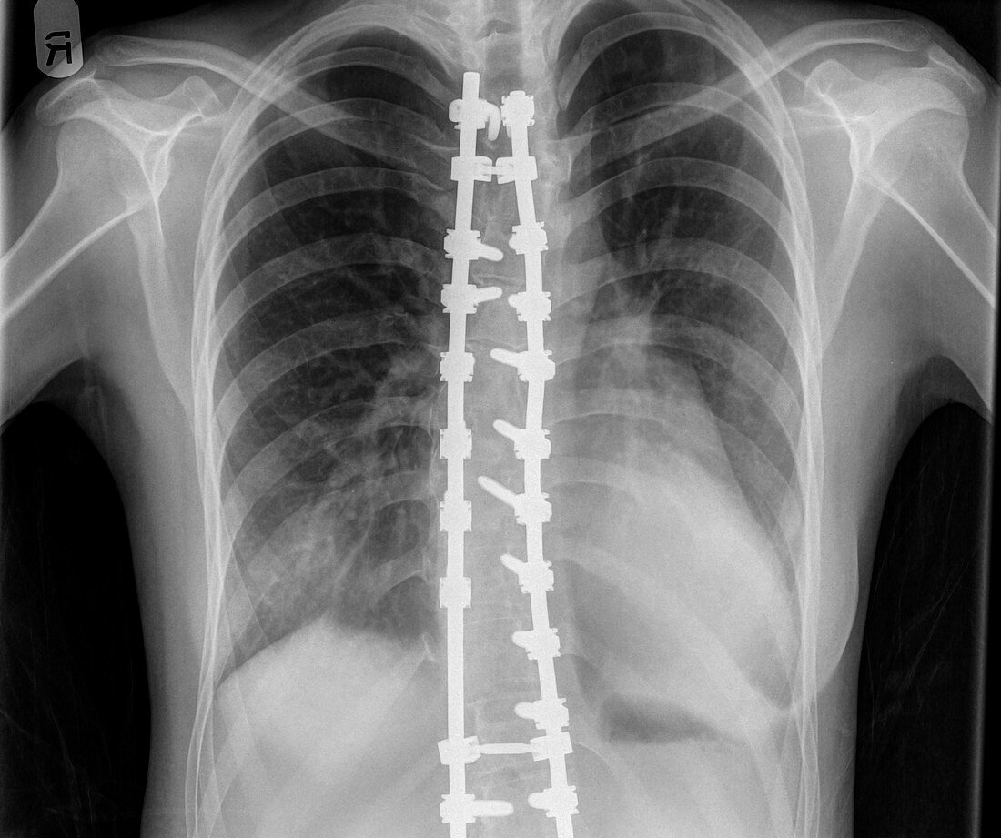 Spinal fusion