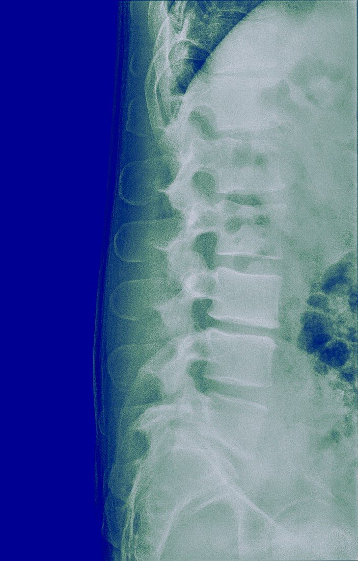 Human Lumbar Spine x-Ray