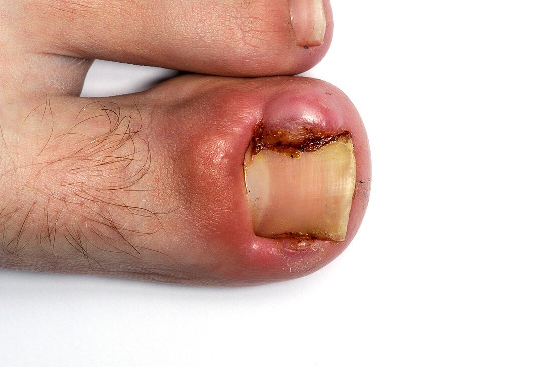 Infected ingrowing toenail