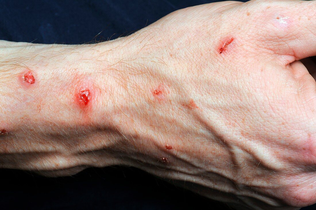 Infected self-inflicted skin lesions