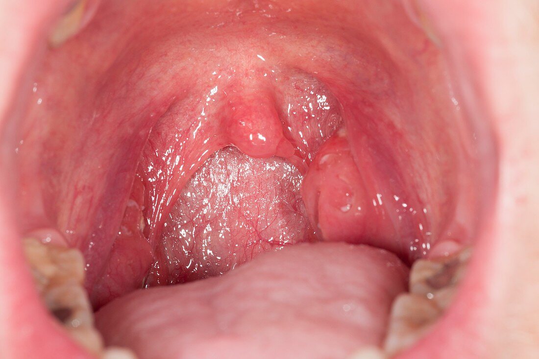 Tonsillitis