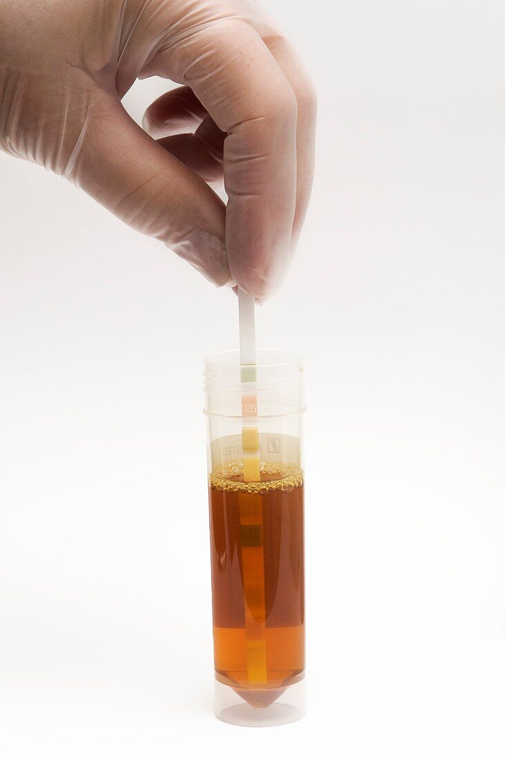 Urine test in patient with jaundice