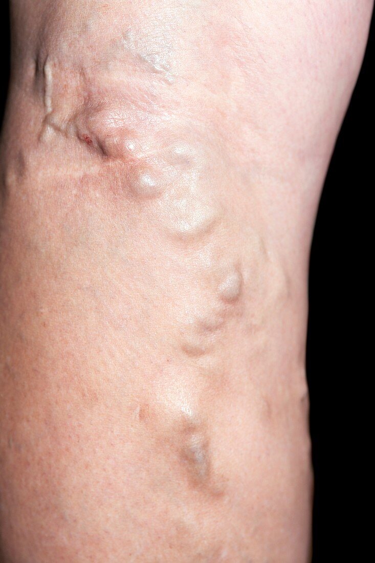 Varicose veins