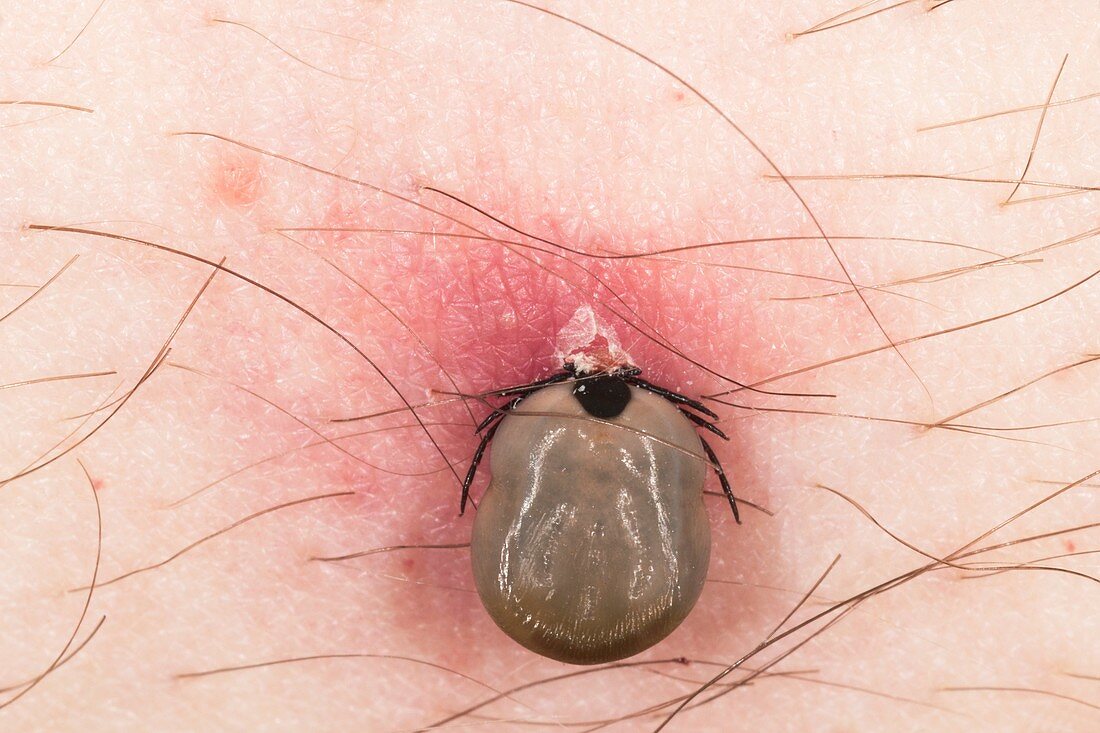 Tick feeding on a man