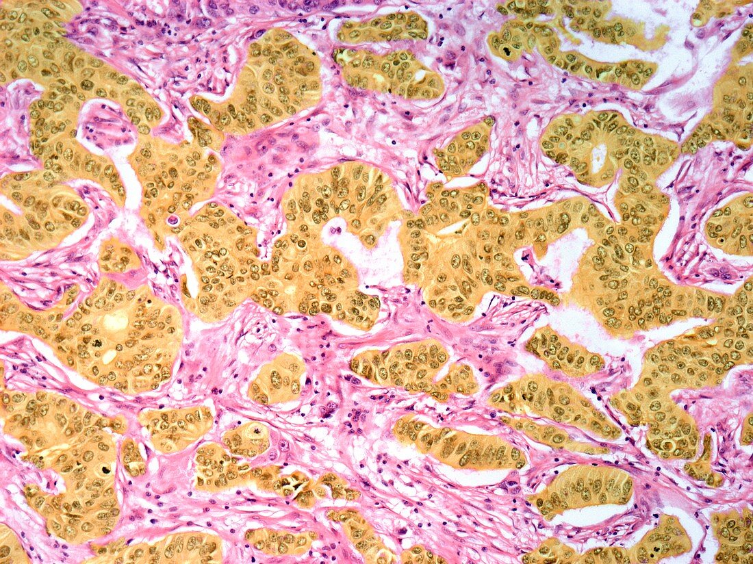 Medullary breast cancer,light micrograph