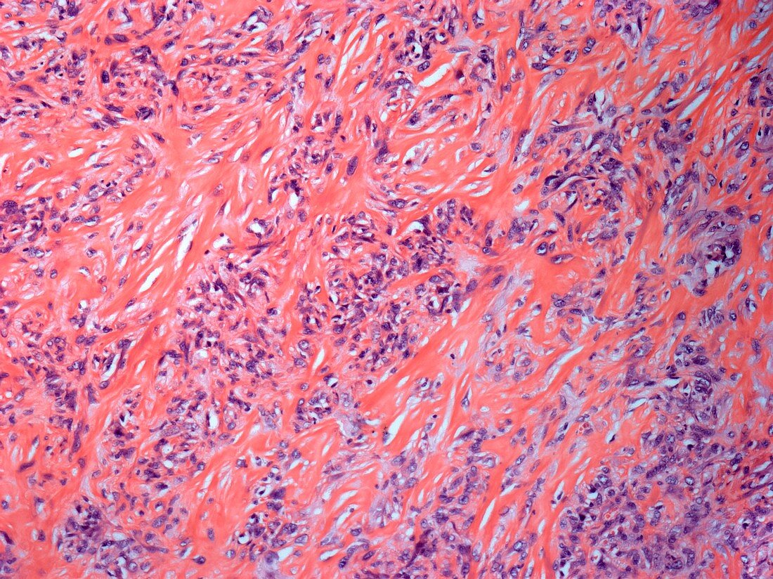 Smooth muscle cancer,light micrograph