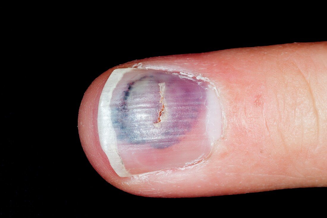 Dog bit on the finger