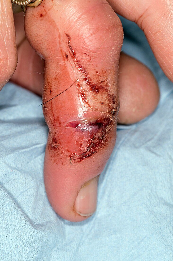 Infected dog bite on the finger