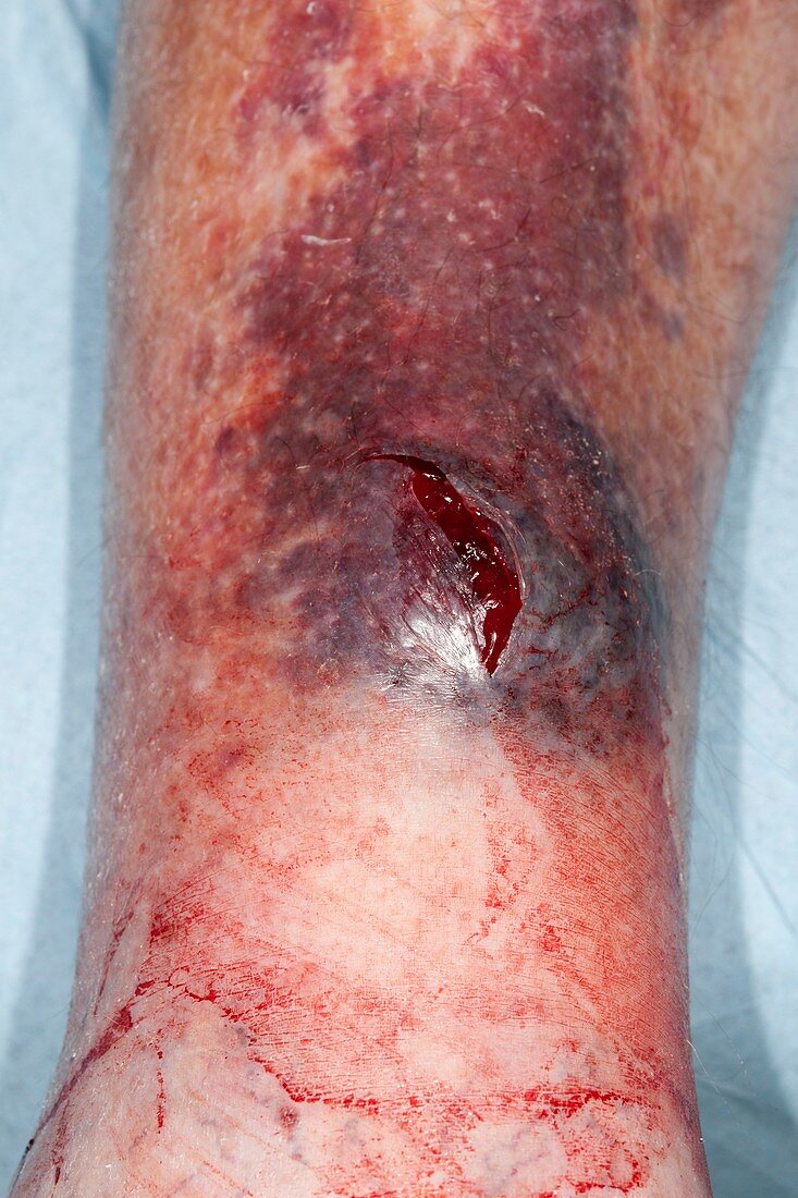 Laceration on leg