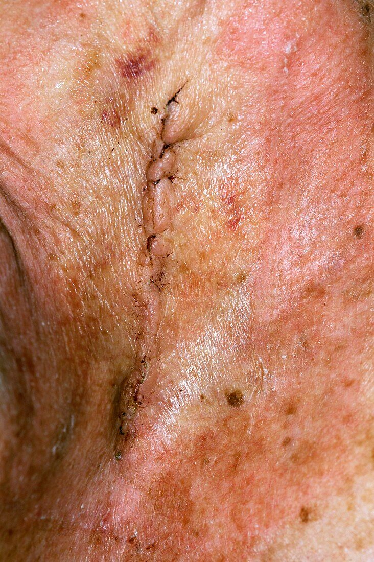 Oesophagectomy scar