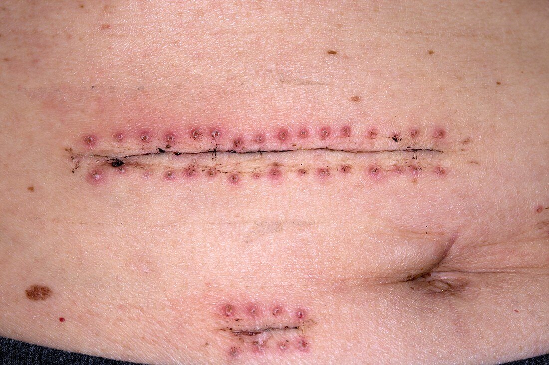 Oesophagectomy scars