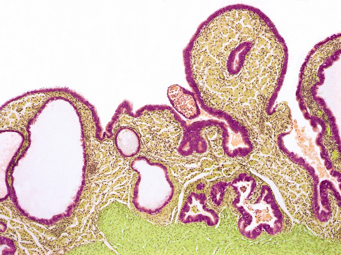 Inflamed fallopian tube,light micrograph