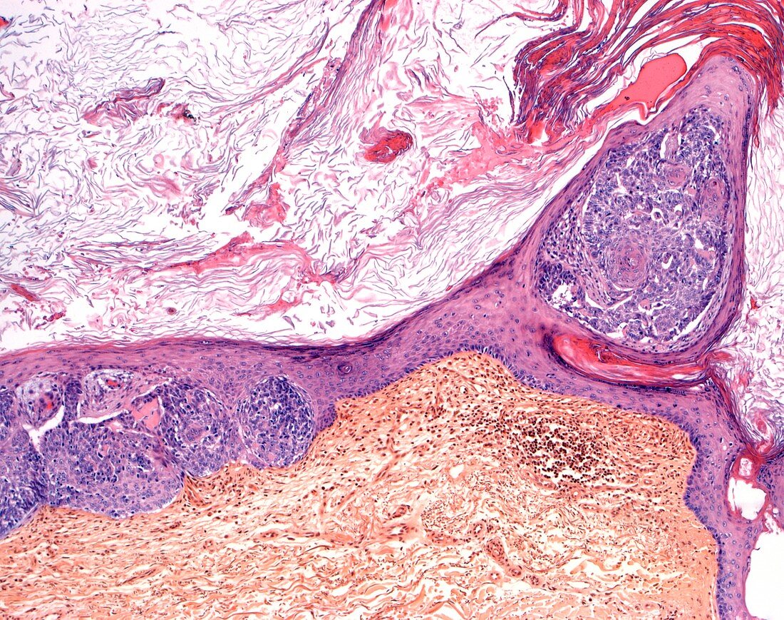 Scalp ringworm,light micrograph