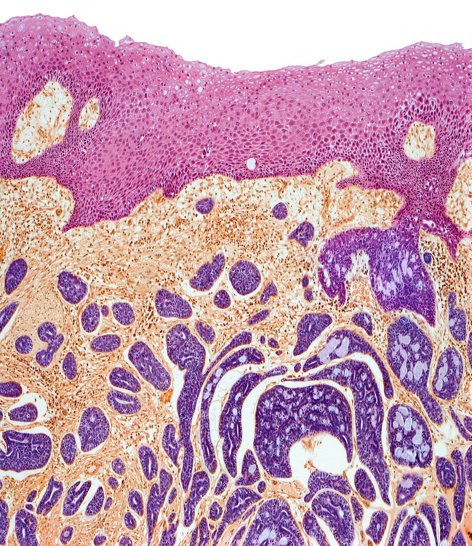 Tongue cancer,light micrograph