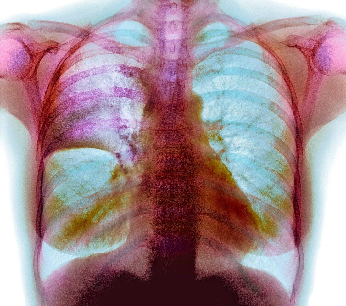 Pulmonary consolidation,X-ray
