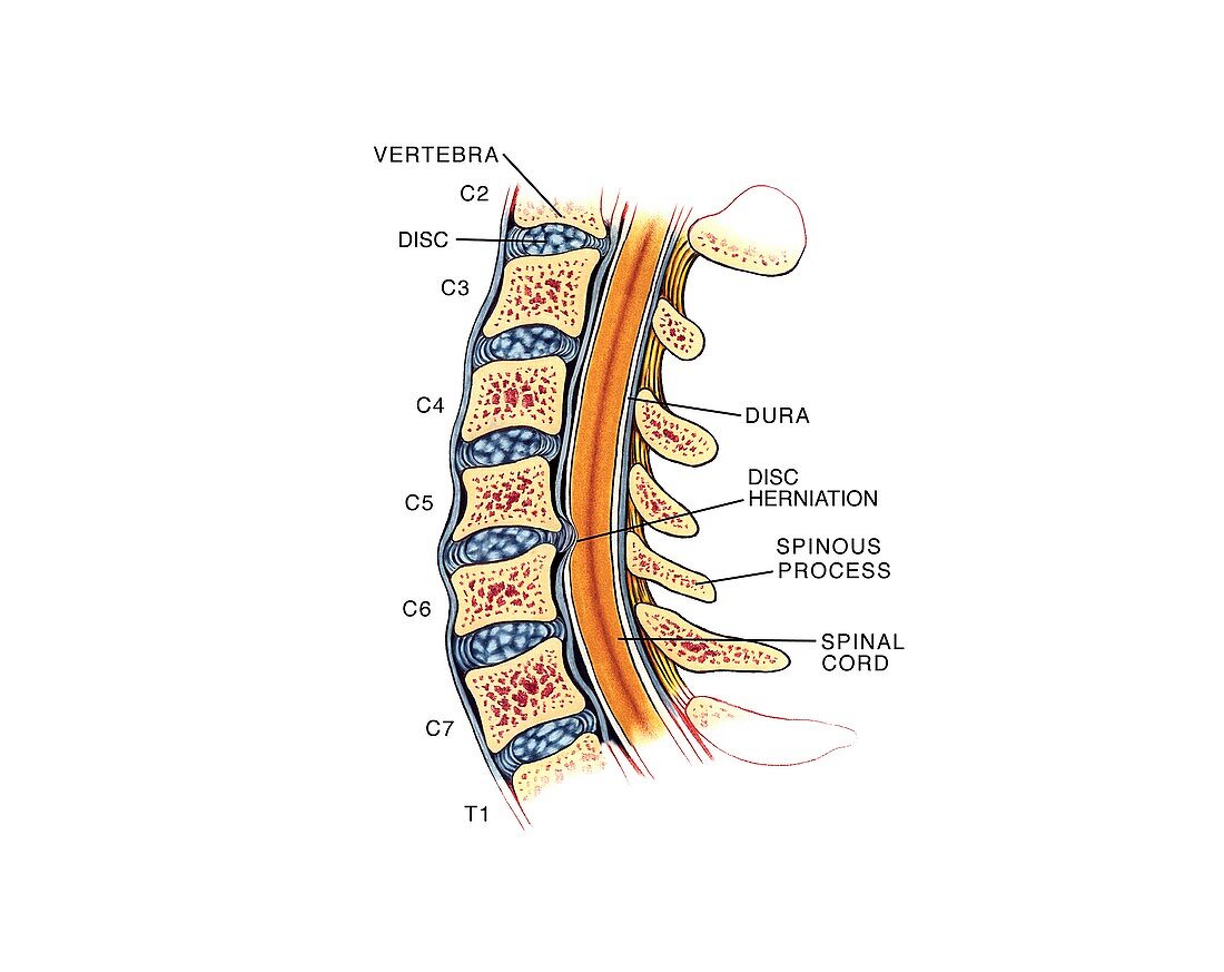Slipped disc in the cervical spine
