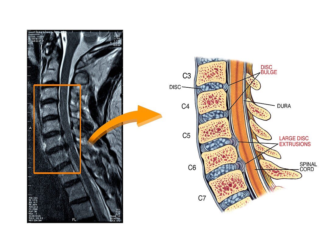 Slipped discs in the cervical spine
