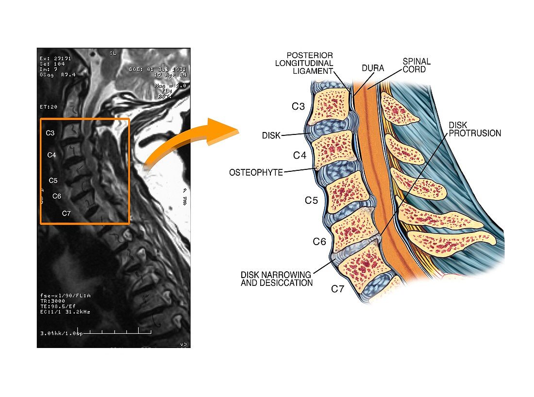 Protruding disc in the cervical spine
