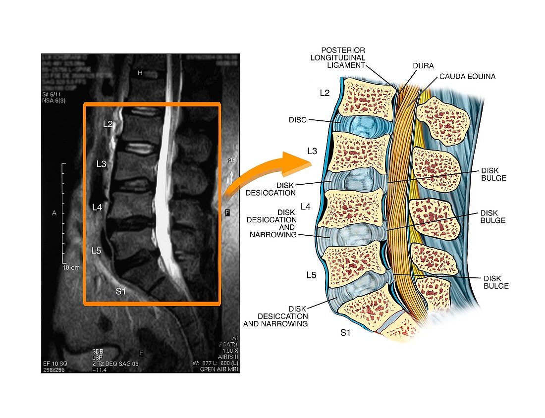 Bulging discs in the lumbar spine