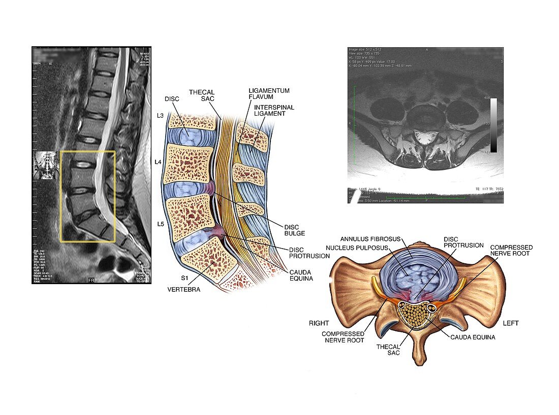 Slipped discs in the lumbar spine
