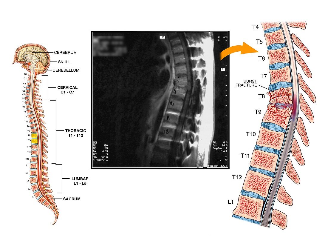 Burst fractures of the thoracic spine