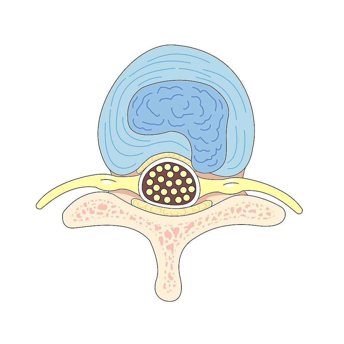 Herniated intervertebral disc