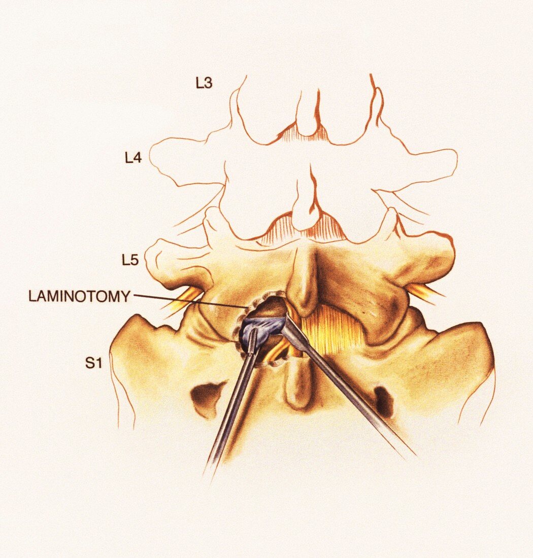 Laminotomy surgery on slipped disc