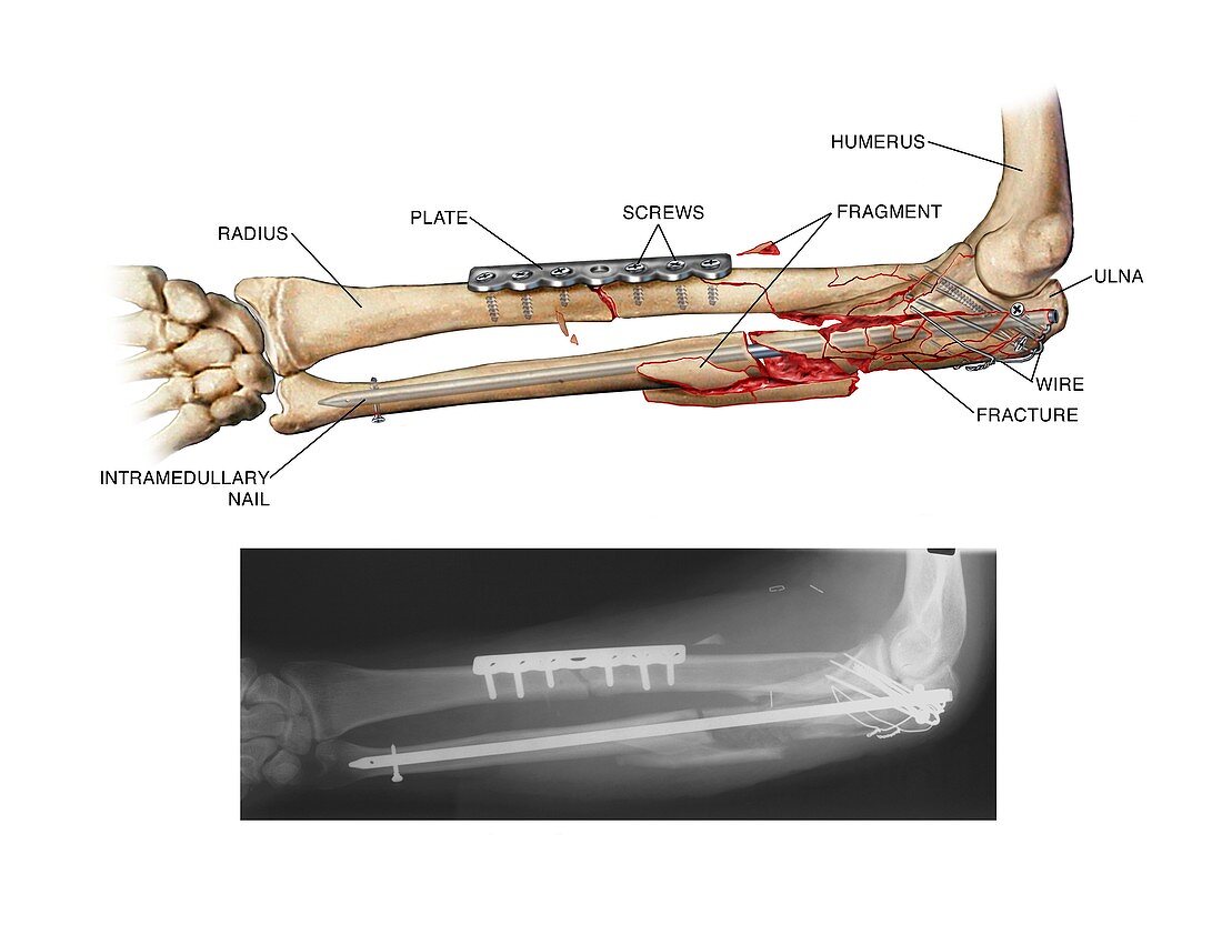 Internal fixation of fractured arm bones